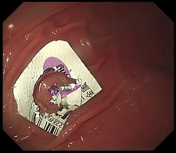 2.6kgチワワが誤飲した胃の中のPTP包装の内視鏡画像