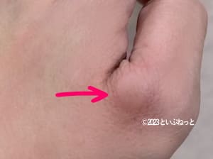 白色ワセリンを塗った後、痒くなって腫れた人の手